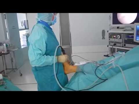 Arthroskopie oberes Sprunggelenk - Arthroscopy ankle joint