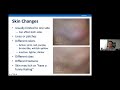 Localized scleroderma overview