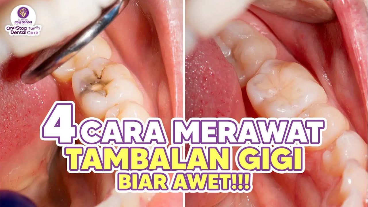 TAMBAL GIGI AWET BERAPA LAMA SIH ? INI DIA 4 CARA MERAWAT TAMBALAN GIGI BIAR AWET