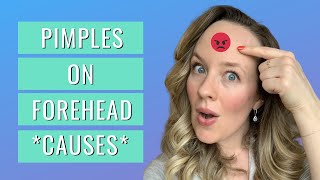 Pimples on forehead meaning - FOREHEAD ACNE TREATMENT!