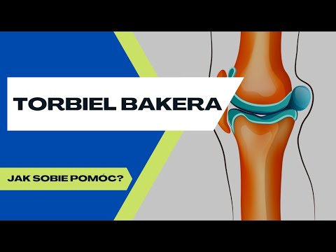 Wideo: Torbiel Bakera