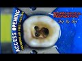 Access Opening Mandibular First Molar | Biomechanical Preparation | step by step
