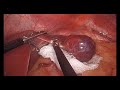 Laparoscopic Liver Resection: Cavernous Hepatic Hemangioma