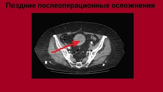 Поздние послеоперационные осложнения.