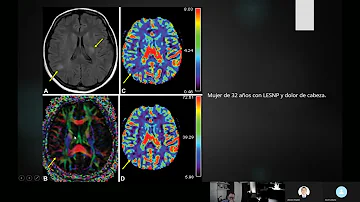 ¿Se puede ver el lupus en una resonancia magnética cerebral?