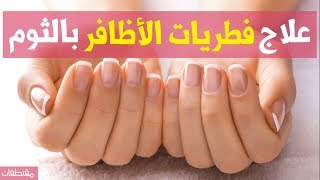 علاج فطريات الأظافر بالثوم