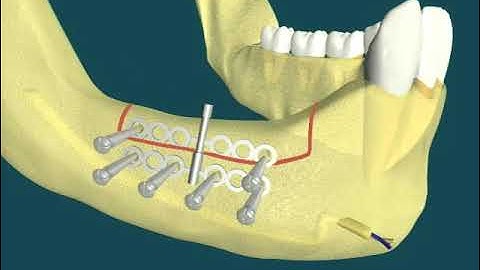 Dental Video of Distraction Osteogenesis