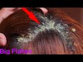 BIG DANDRUFF FLAKES Scalp scratching and picking Satisfying Dandruff Removal # 12