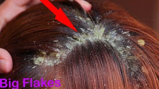 Psoriasis scalp removal videos. Ideiglenesen le vagy tiltva