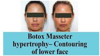 Botox Masseter Hypertrophy- Contouring Of Lower Face | Dr. Debraj Shome