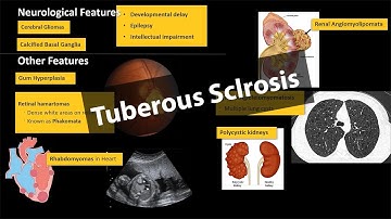 Tuberous Sclerosis - Pathology & Clinical Features (WITH PHOTOS)