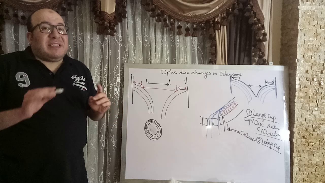 Glaucoma : Optic disc changes