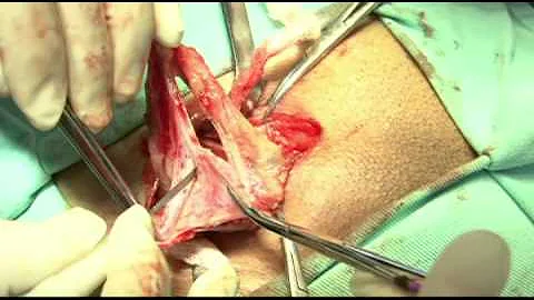 Como se coloca uma tela em uma cirurgia de hérnia?