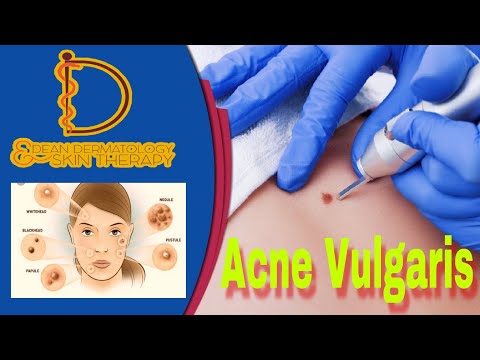 Acne Vulgaris (types & treatments)