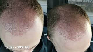 hair transplant in Bellus clinic