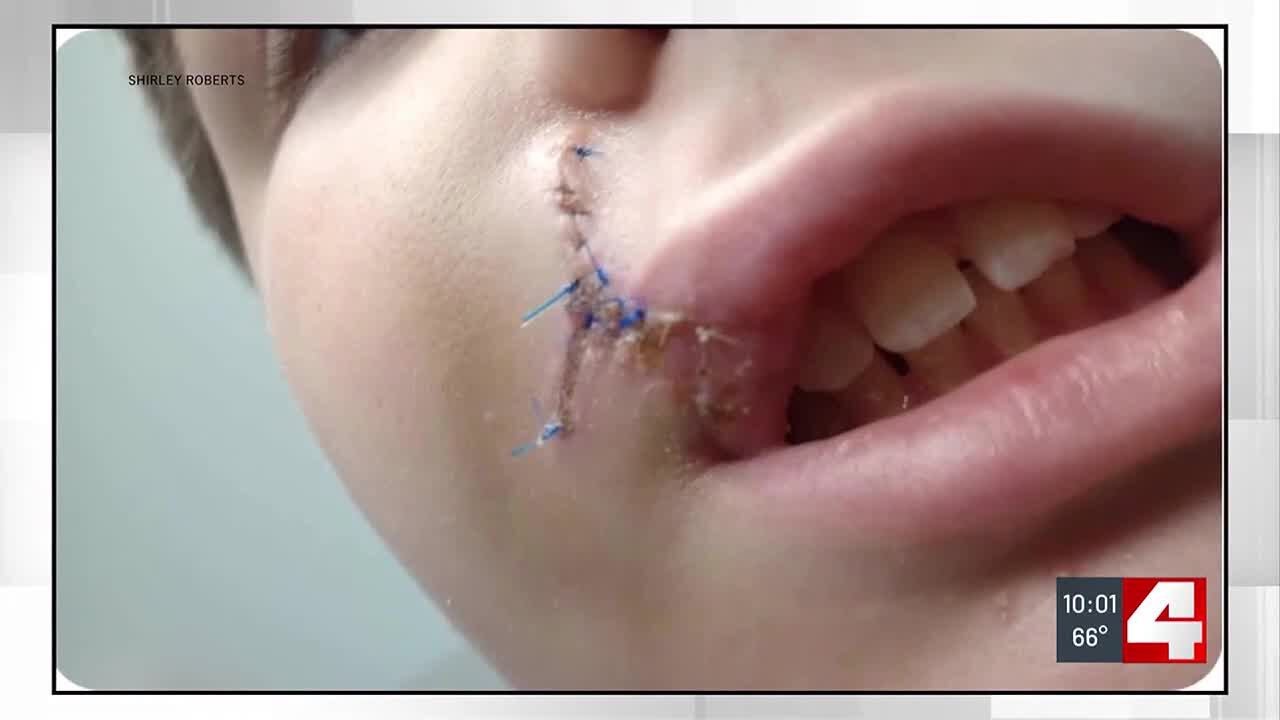Granite City boy requires surgery after dog attack - YouTube