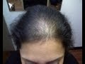 Rapid Hair Loss - Telegen Effluvium [DermTV.com Epi #516]