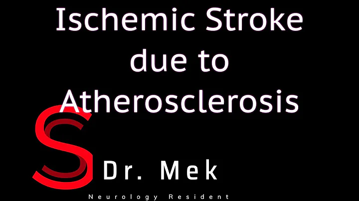Strike Stroke with Dr. Mekdes: Ischemic stroke due to atherosclerosis (E6)