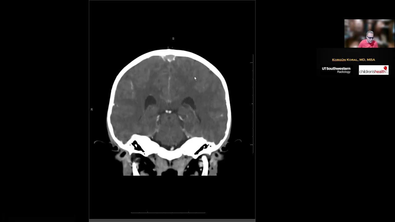 Dural Venöz Sinüs Trombozu