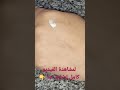 الطريقة الصحيحة لإستخدام كريم تريتوسبوت المقشر لإزالة آثار الحبوب والندبات 