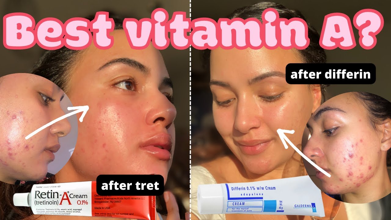 Tretinoin vs adapalene for acne dryness results purging retin a or