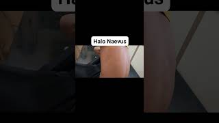 Halo Naevus dermatologist Dr Bhutada Skin India