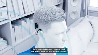 Wie funktioniert ein CochleaImplantat?