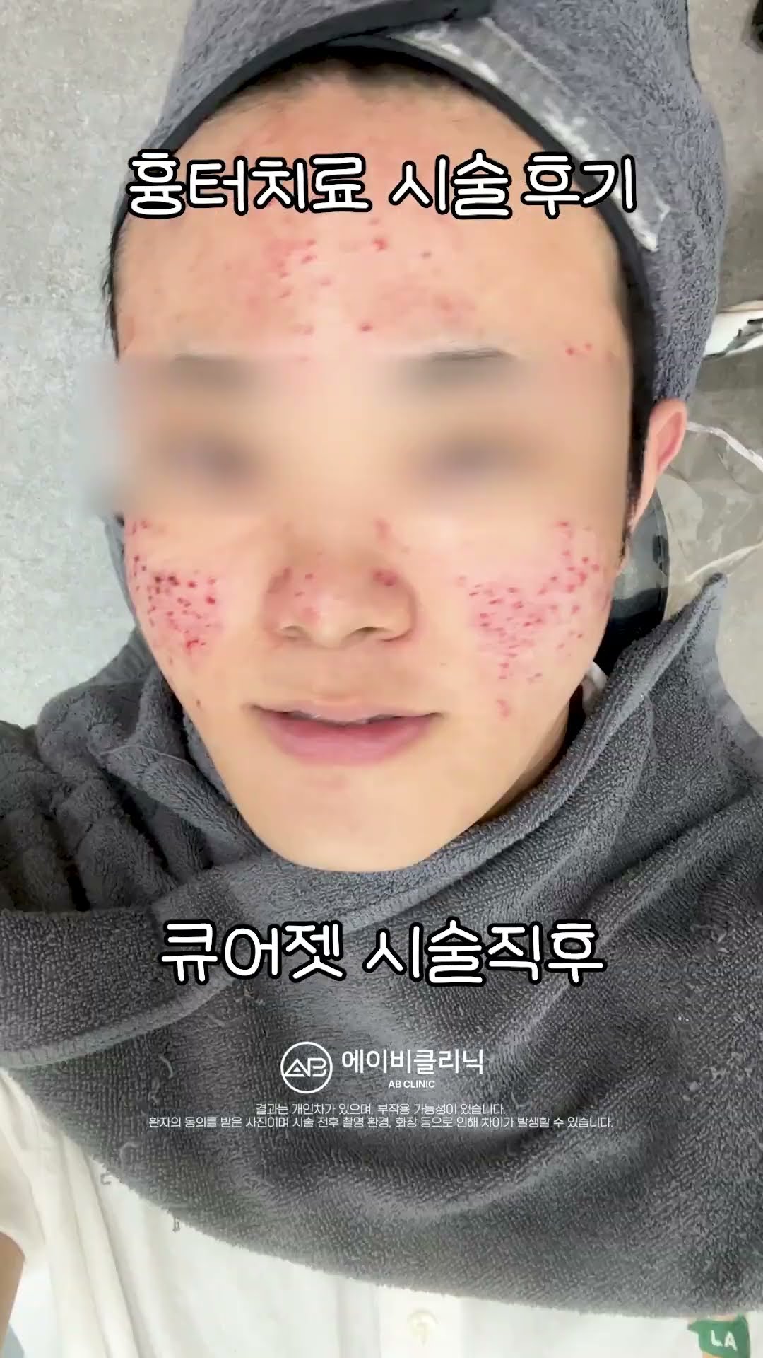 흉터 치료 큐어젯 시술 과정