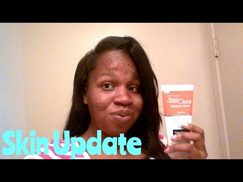 Dealing with Acne while pregnant (Skin Update)