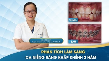 PHÂN TÍCH LÂM SÀNG CA NIỀNG RĂNG KHẤP KHỂNH CHỈ ĐỊNH NHỔ 2 RĂNG CỬA HÀM DƯỚI