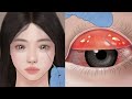 Satisfying eye stone removal animation conjunctivitis treatment no music