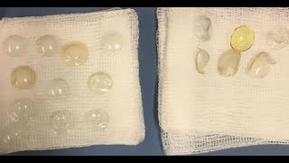 ★ Doctors Find 27 Contact Lenses in Woman's Eye