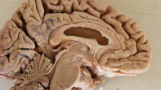 Third Ventricle / neuroanatomy / boundaries / recesses