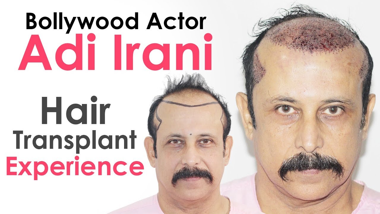 Celebrity Hair Transplant Top Celebrity Hair Transplant Center