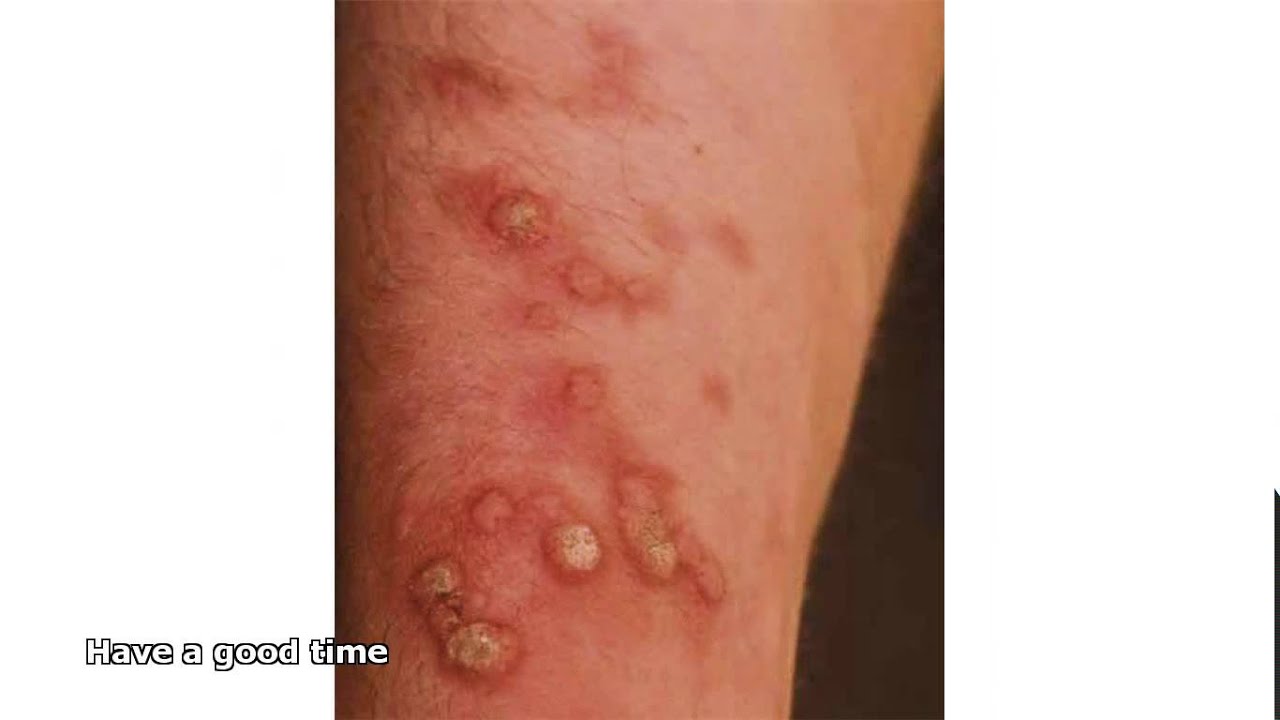 fungal skin infections 