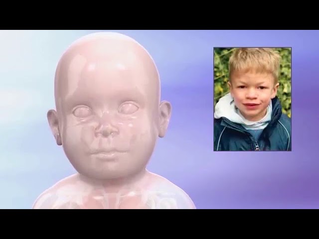 Руководство по синдрому Хантера (МПС II)