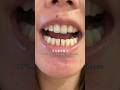 The Hidden Mistake That Destroys Perfect Smiles After Braces | Dr Tooth Dental MY #smilemakeover