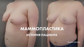 ВТОРИЧНАЯ МАММОПЛАСТИКА – ИСТОРИЯ ПАЦИЕНТКИ