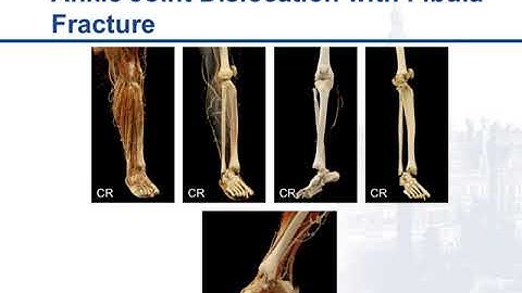 Cinematic Rendering: Principles, Applications, and Observations in CT Part 2