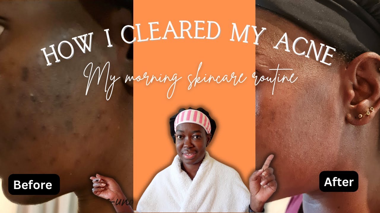 This is how I cleared my acne | My morning skincare routine. - YouTube