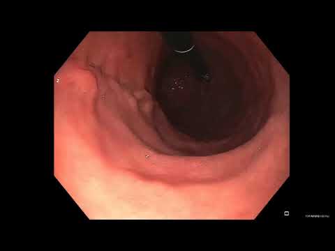 Video J Shaped Stomach Endoscopy