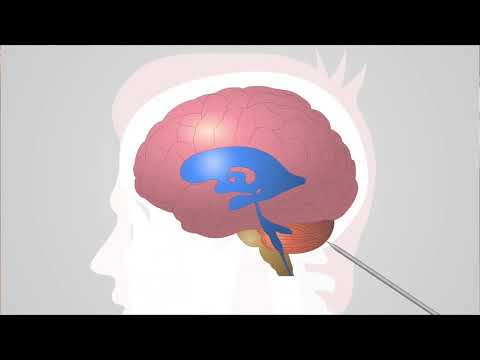 Video: Hydrocephalus I Hjernen Hos Barn Og Voksne, Behandling