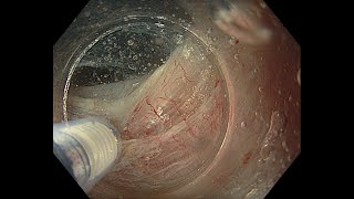 Undersaline POEM  combined with partial myotomy for hypercontractile esophagus (Endoscopy 2025)