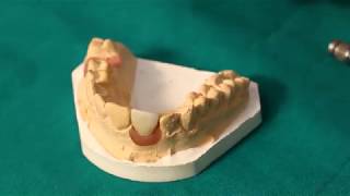 Dynamic Abutment Solutions / How to change access holes in unfavourable implant angulations