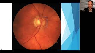All About Glaucoma