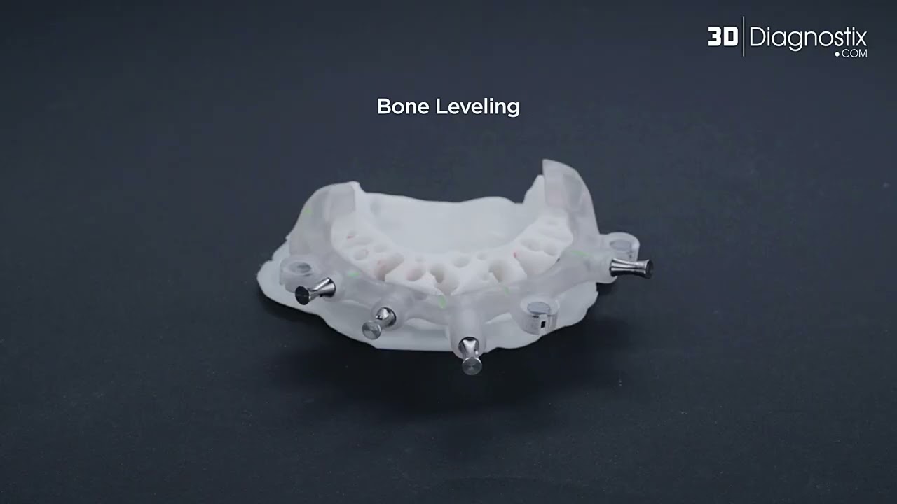 MagnetiX™ Stackable Guides & PMMA | Hands-On Digital Surgery Tutorial