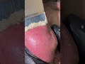 Nose removal black head