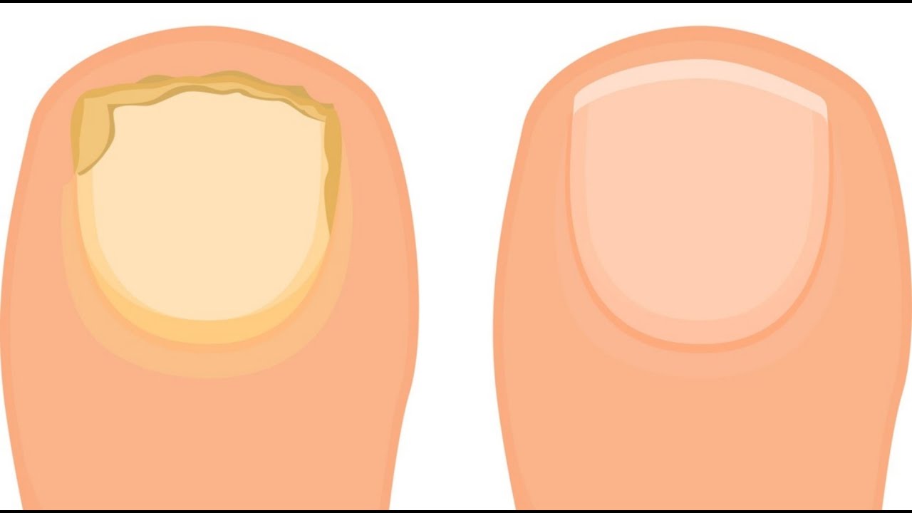 Лечение грибка ногтя врач. Гипертрофический онихомикоз. Нормотрофический грибок. Онихомикоз ( обработка грибковых ногтей).