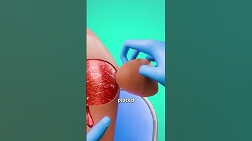 How Skin Transplant Work 😲