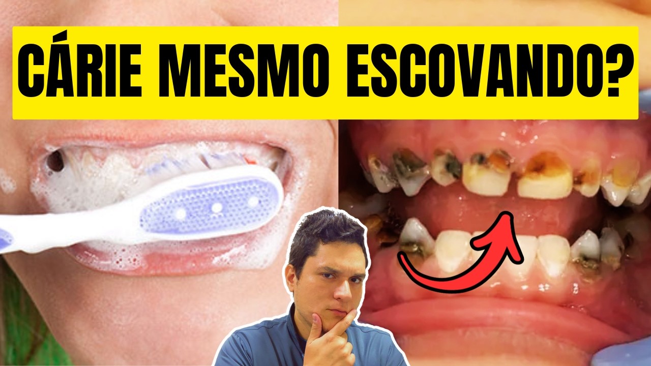 Por que algumas pessoas têm cárie mesmo escovando os dentes? - YouTube